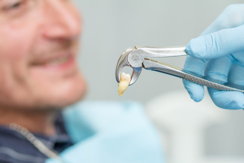 Dental International cirugía muelas del juicio